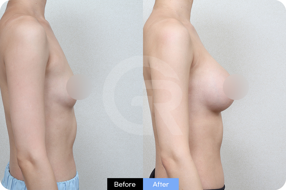 Girin Plastic Surgery Korea Breast Augmentation case 02 Side