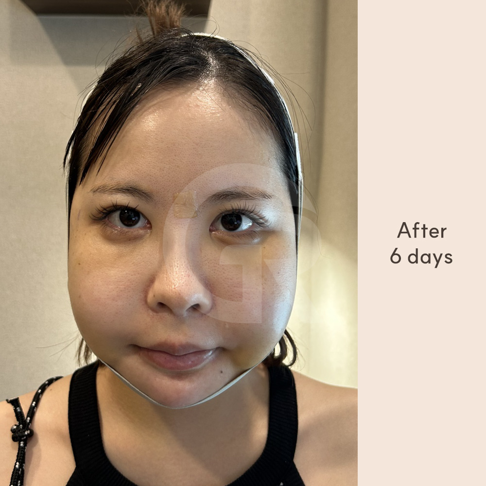 SSRO mandible surgery technique used to adjust lower jaw position while maintaining jaw angle and ensuring structural stability.
