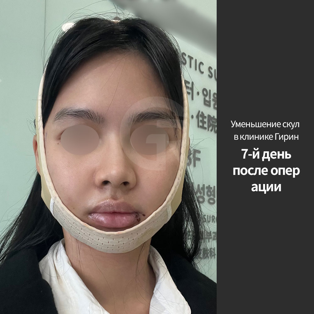 Естественно красивый контур лица формируется за счет гармоничного соединения висков, скул, щек, линии челюсти и подбородка.