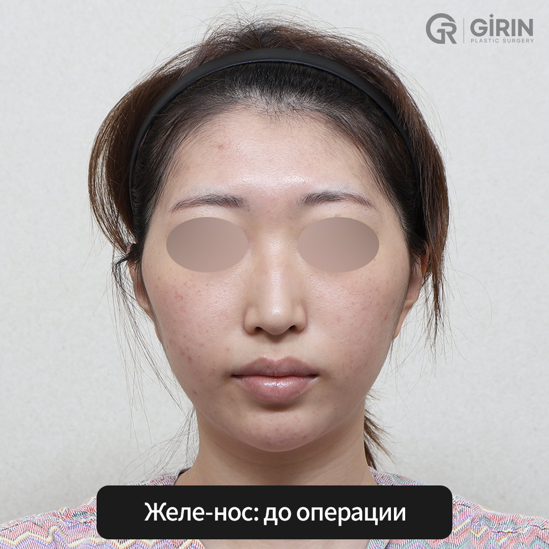 Безразрезная корейская ринопластика — фото до и после
