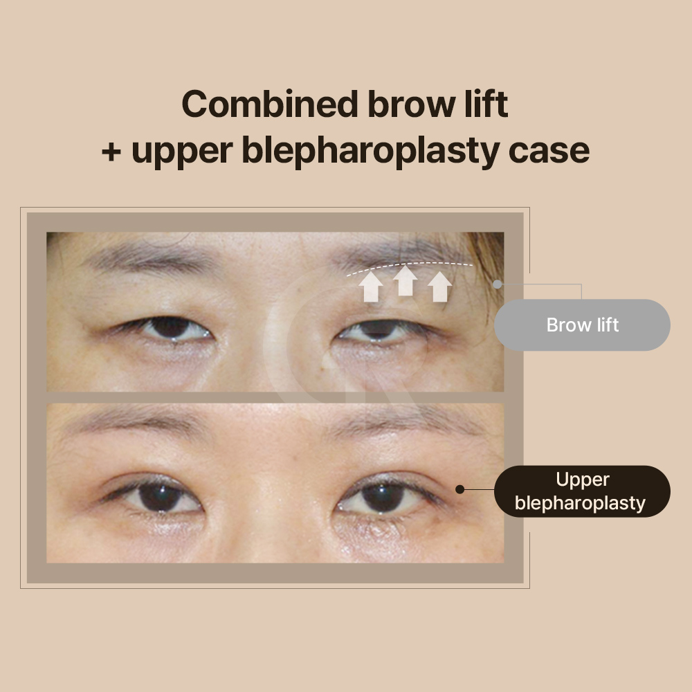 Fat repositioning under the eyes creates a smoother and more natural contour than simple removal.