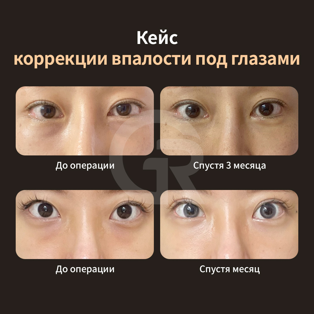 Нижняя блефаропластика удаляет избыточную кожу, сохраняя естественное выражение лица.