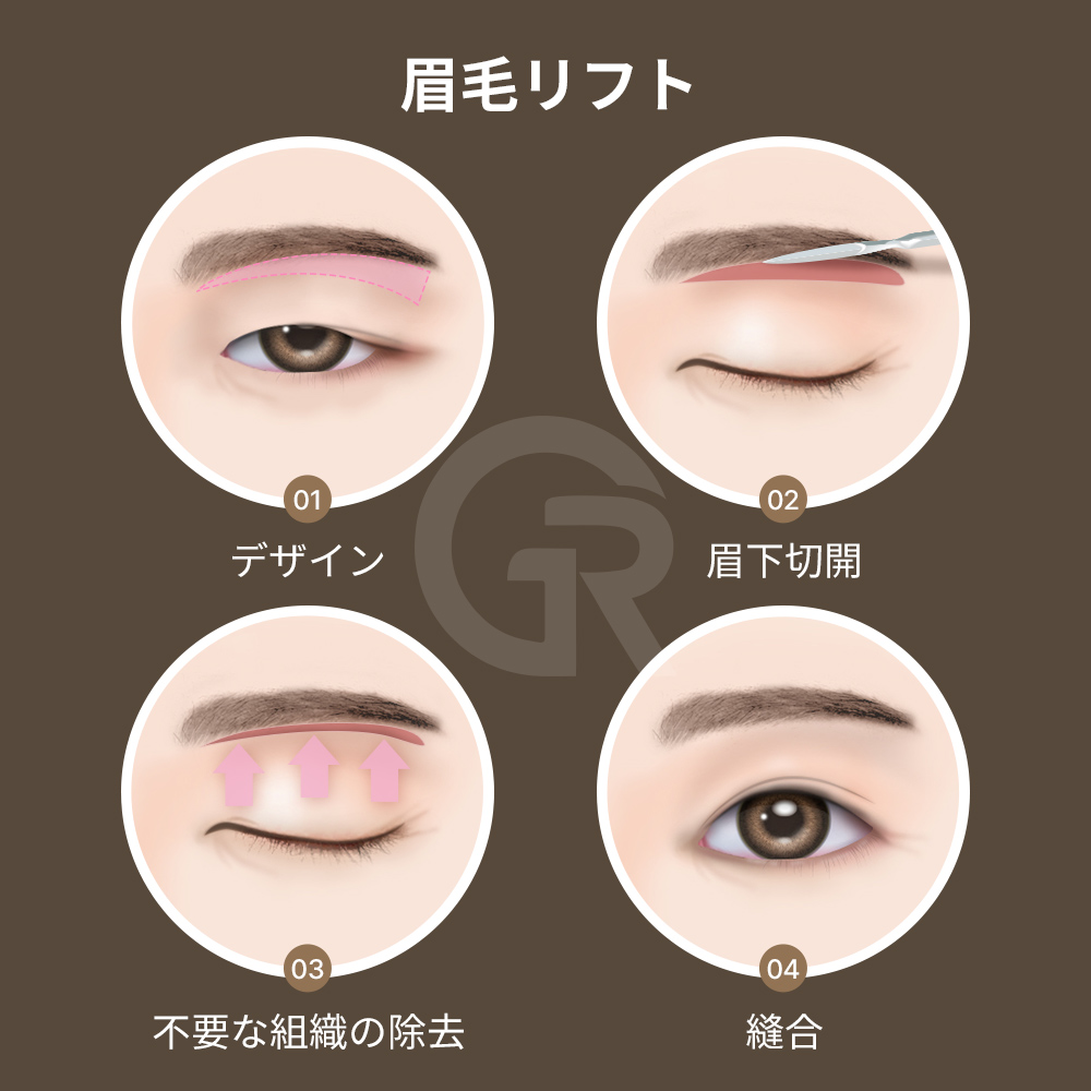 額リフトは眉の位置を改善し、自然に目を開けやすくします。