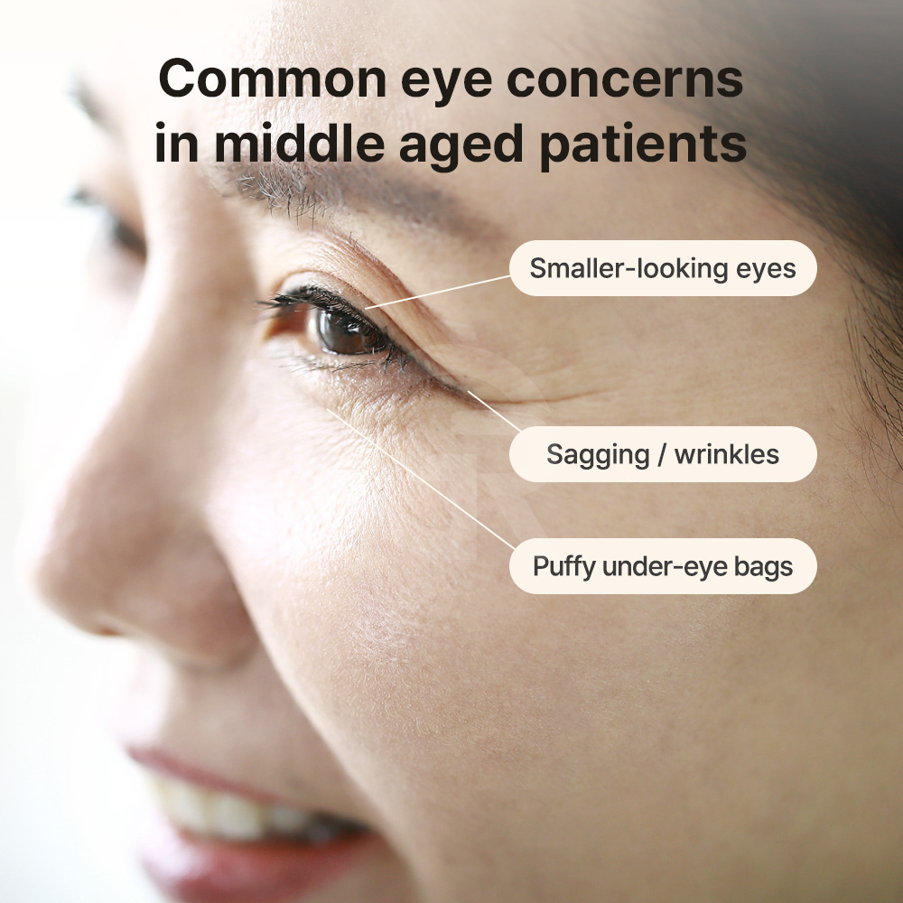 Middle-aged patients often notice smaller and heavier-looking eyes due to combined eyelid and brow descent.