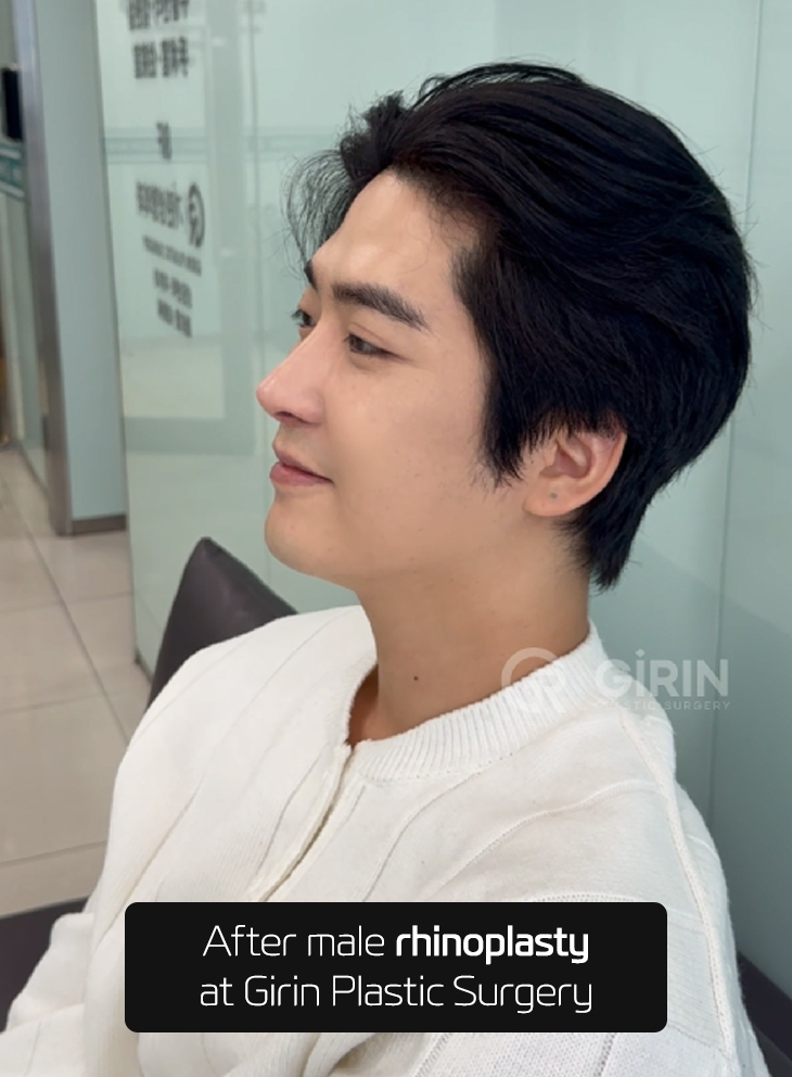 Natural before-and-after results of male rhinoplasty in Korea.