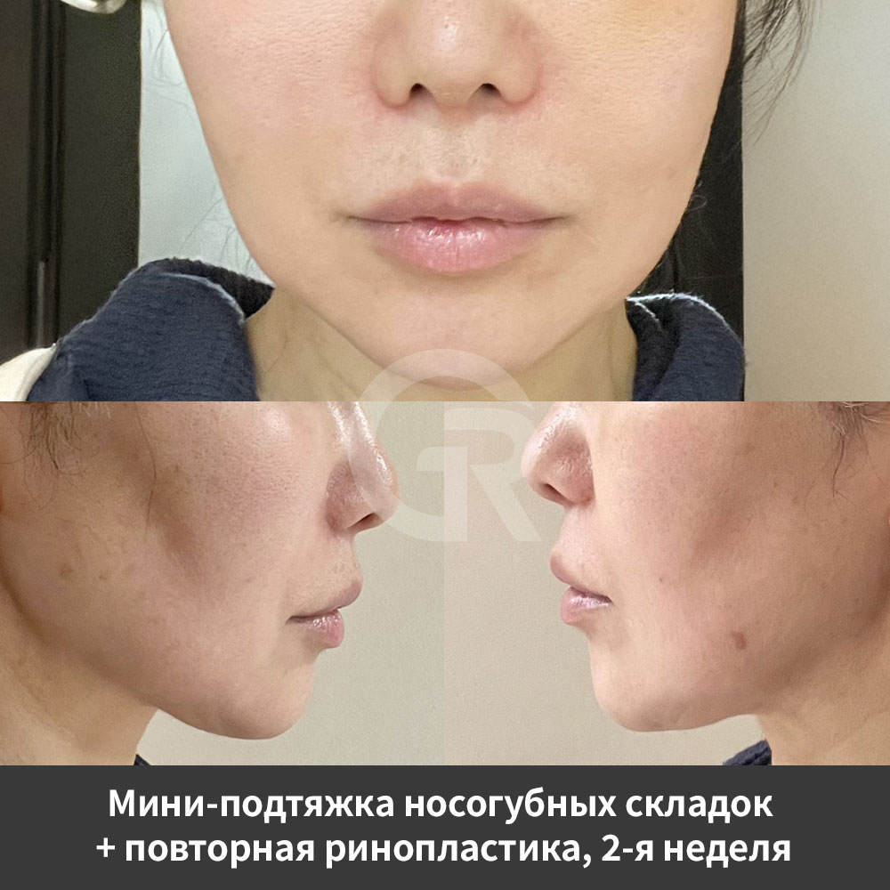 Операция в клинике Гирин в Каннаме показывает, как повторная ринопластика и коррекция возрастных изменений могут планироваться вместе.