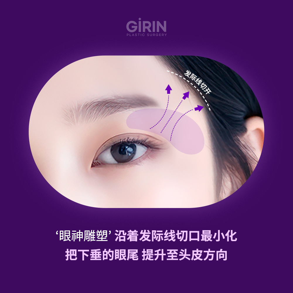 太阳穴提升术通过筋膜固定实现长效效果。