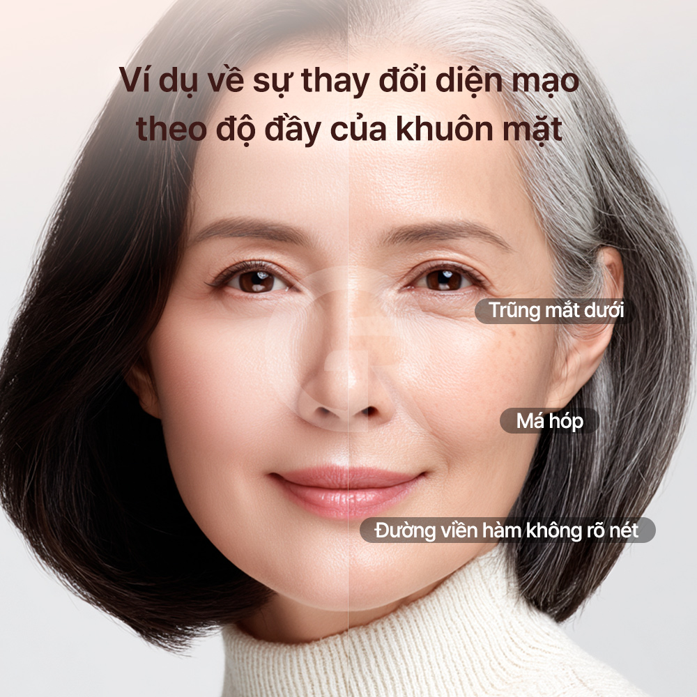 Cấy mỡ tự thân sử dụng mỡ của chính cơ thể, giúp giảm tương đối nguy cơ dị ứng hoặc phản ứng với dị vật.