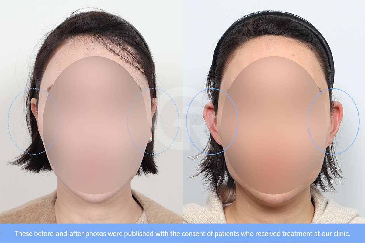 Before and after results of lop ear surgery in Korea showing improved ear visibility and facial balance.