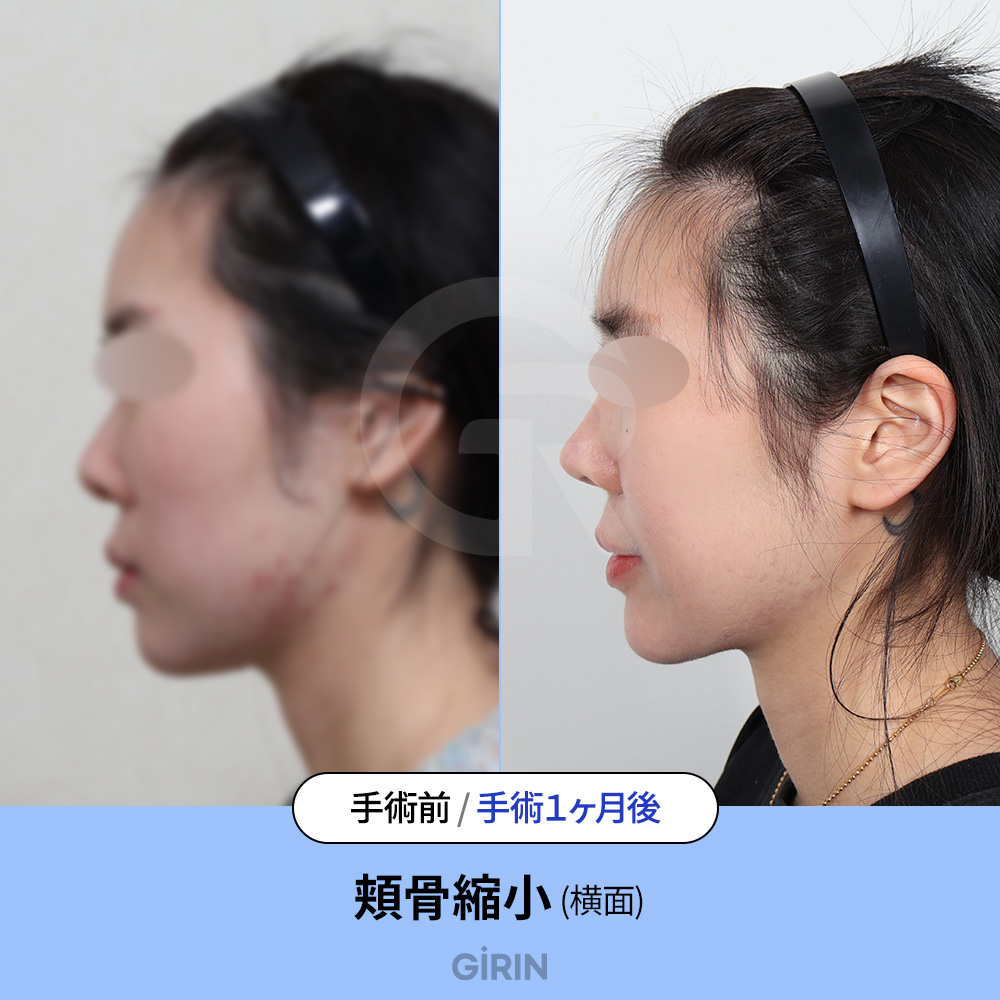 韓国式の頬骨縮小は「自然な調和」を重視します。