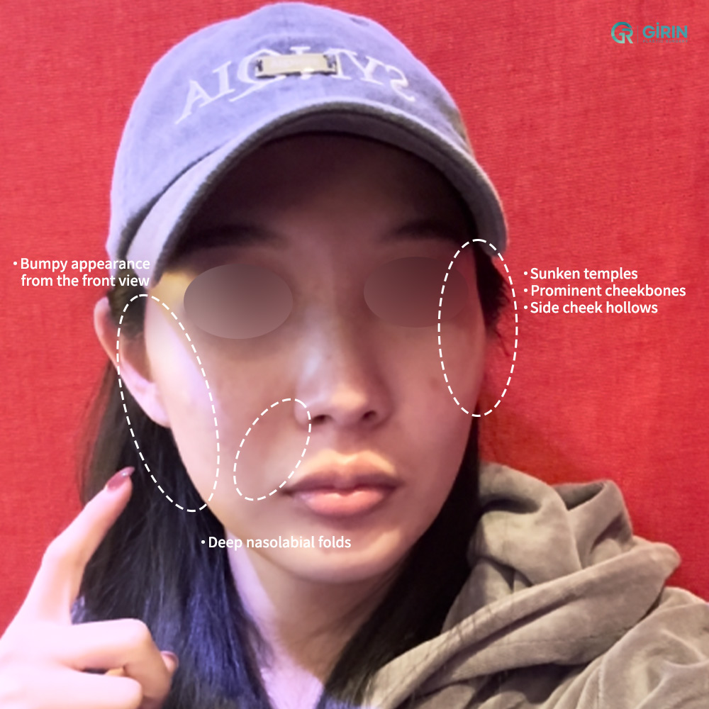 Evaluating the temples, cheekbones, and lateral cheeks together is essential for facial contour analysis.