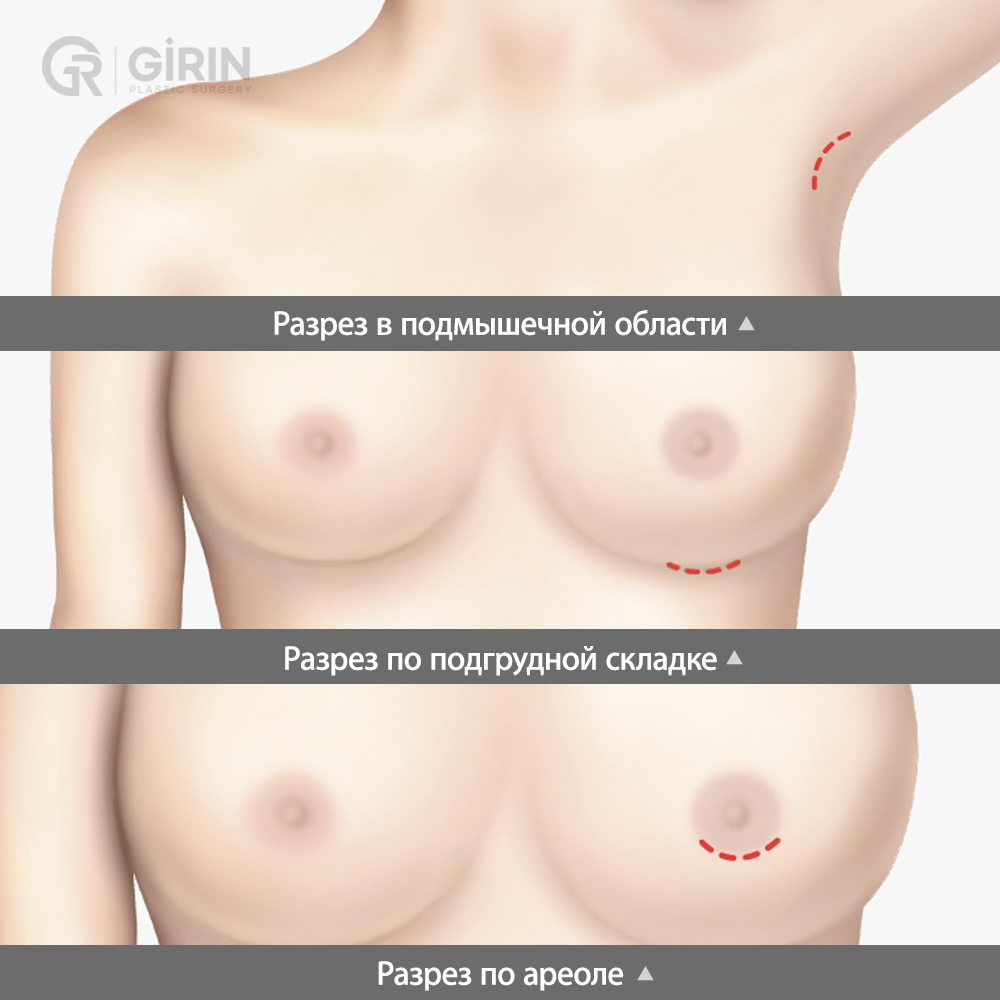 Выбор оптимальной зоны разреза под особенности тела