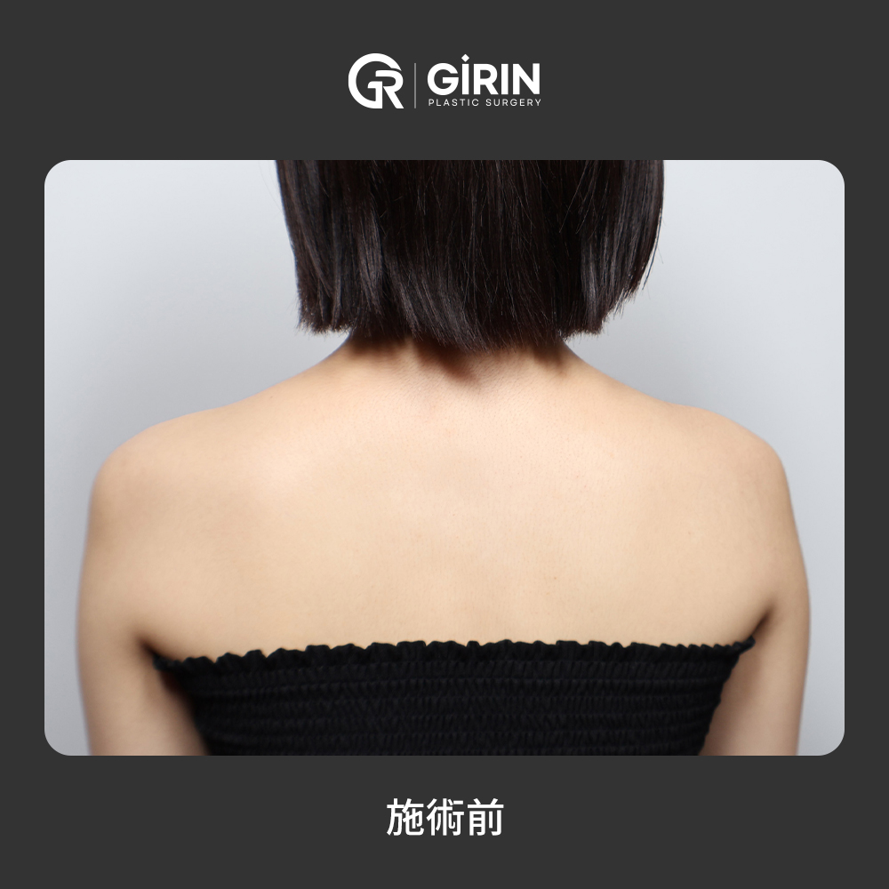 肩幅を広げたフィラーデザインのポイント