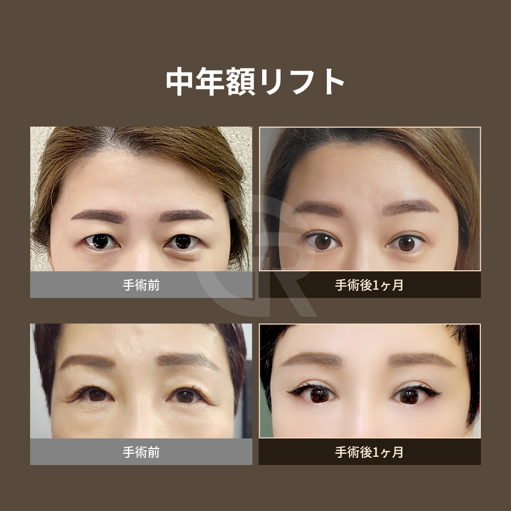 眉下リフトは二重ラインを変えずに、目元の印象を改善する方法です。