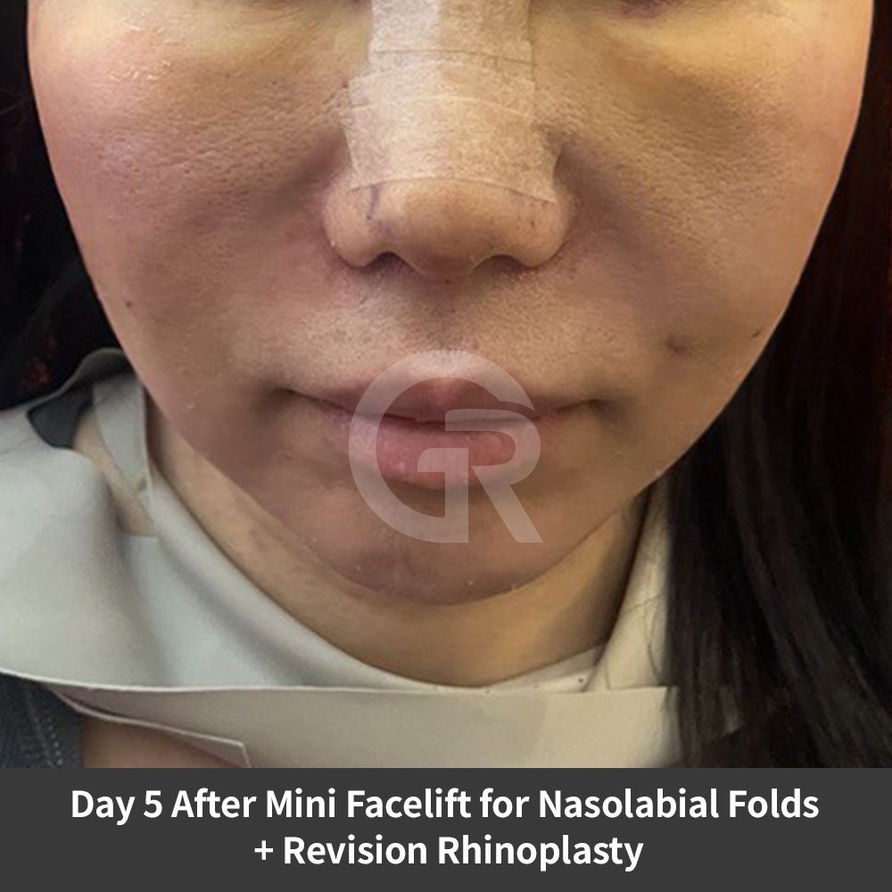 A review of deep nasolabial fold and marionette line improvement at Girin Plastic Surgery in Korea for those considering facial anti-aging surgery.