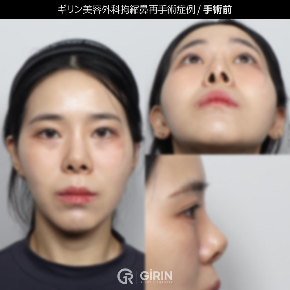 鼻整形再手術のビフォーアフター