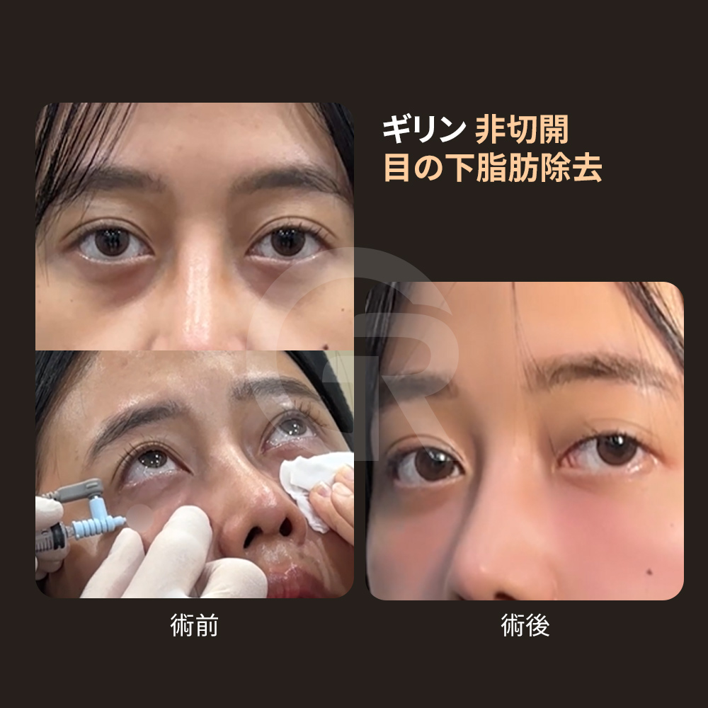 涙溝のくぼみは、顔全体を疲れて見せる原因になります。