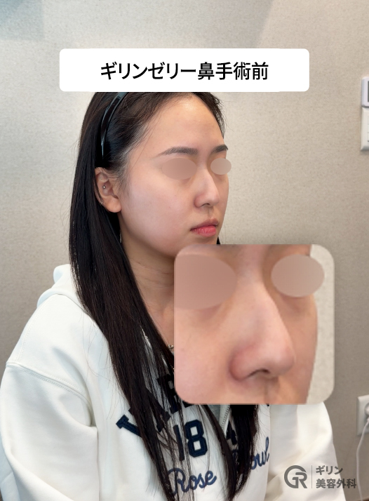 切らない韓国式リノプラスティ ― 自家軟骨ジェリコ法のすべて : 韓国