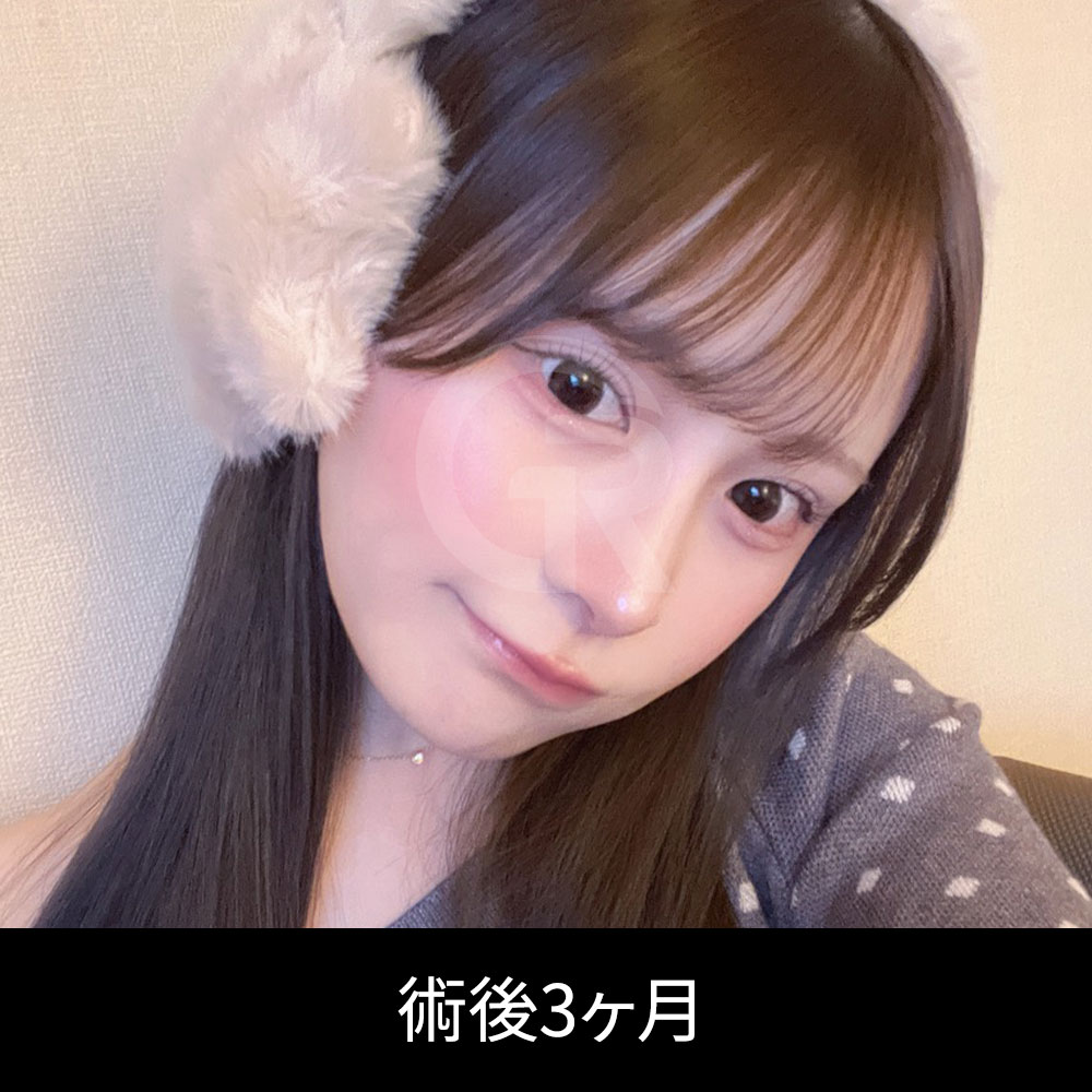 鼻筋が曲がっている場合、高さを出しすぎると左右差がより目立つことがあります。