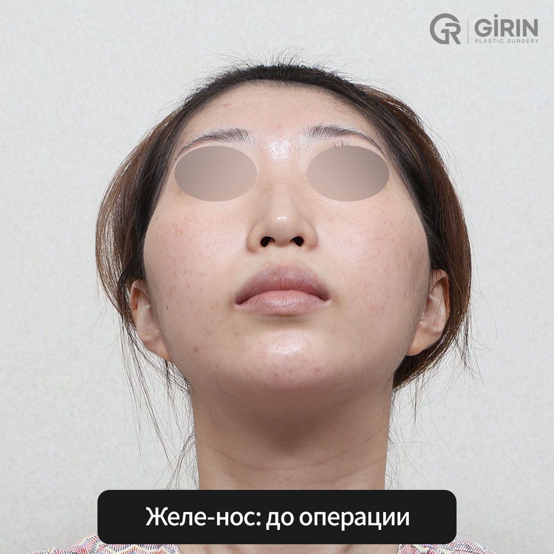 Сравнение результатов: филлер против безразрезной ринопластики