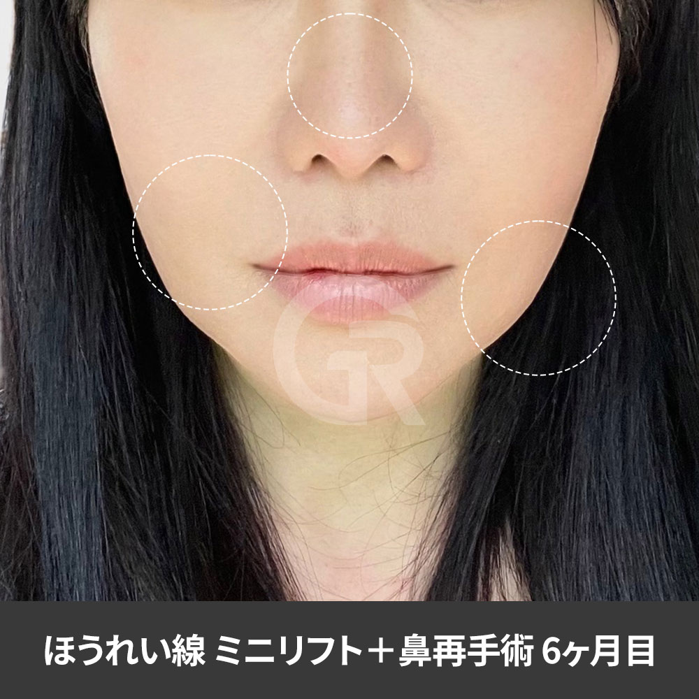 過去の鼻整形による拘縮や短く見える鼻は、中顔面の老け見えにも影響することがあります