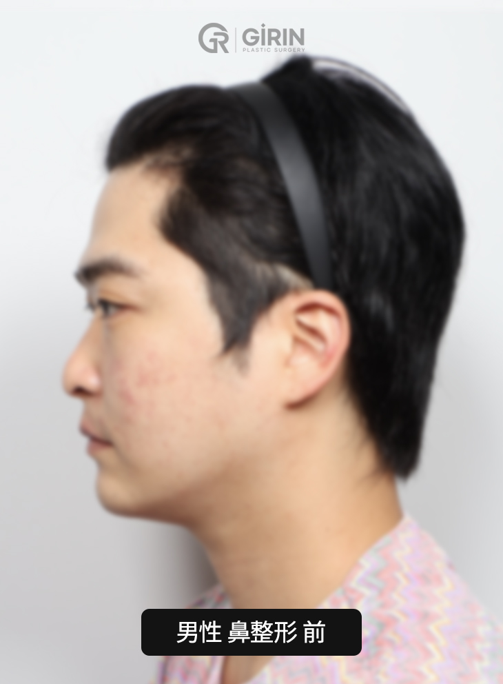 韩国驼峰鼻矫正专科专家团队。