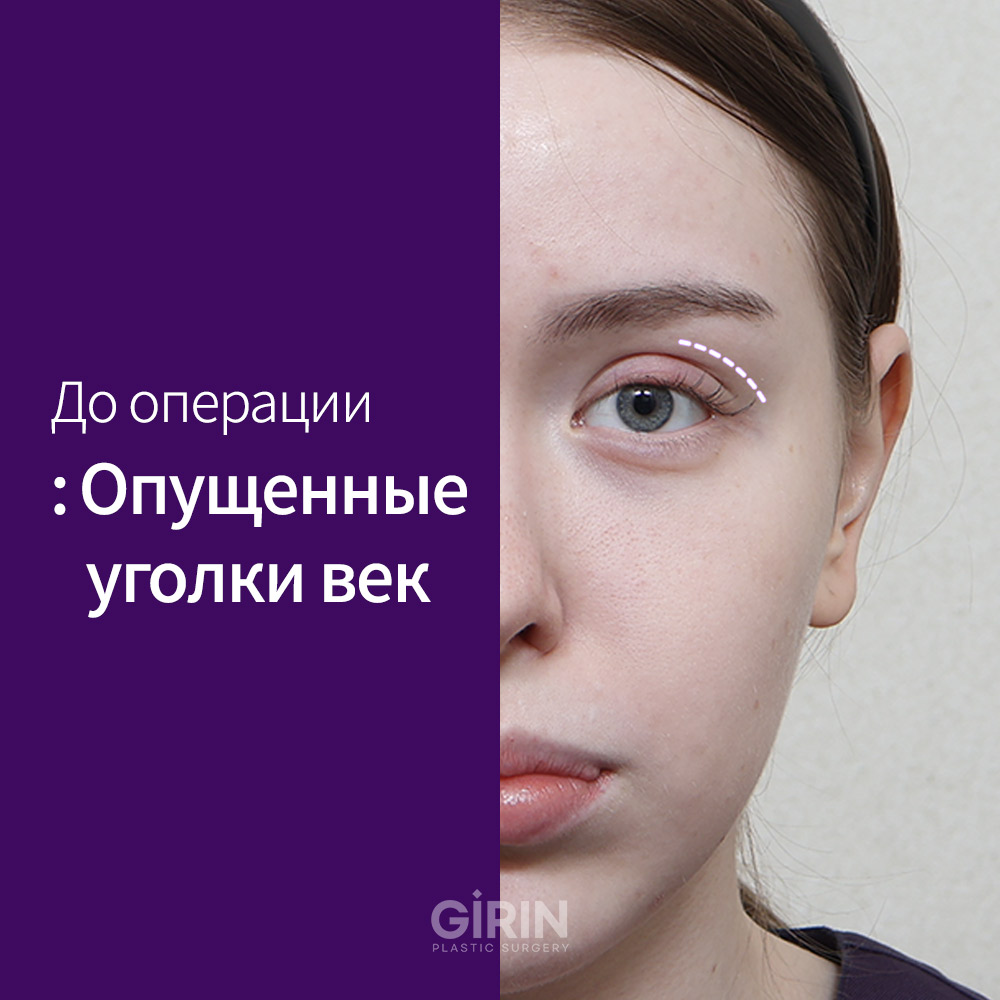 Индивидуальный расчет угла лифтинга в клинике Гирин.