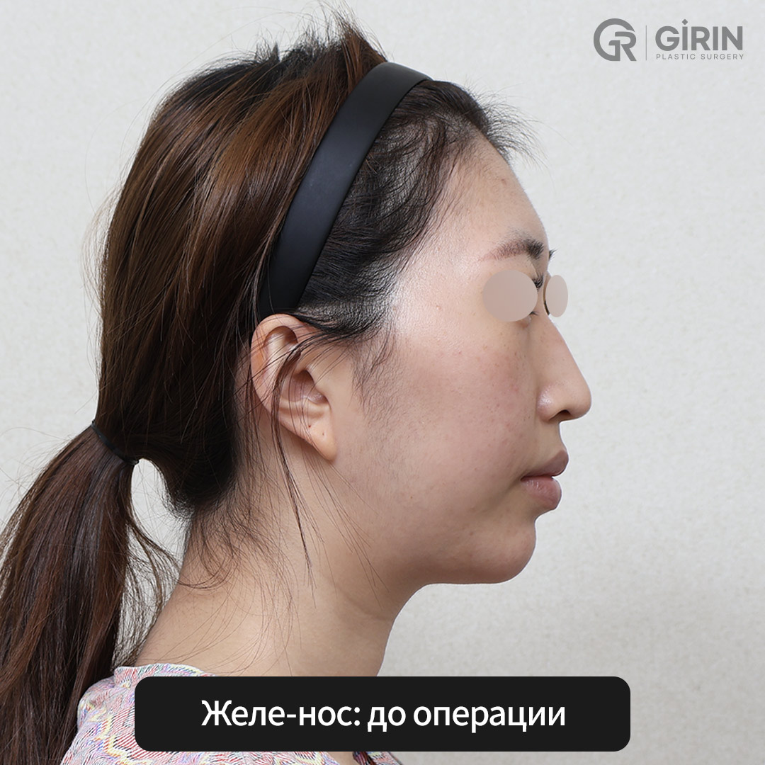 Техника Jellyko — точная и щадящая коррекция формы носа