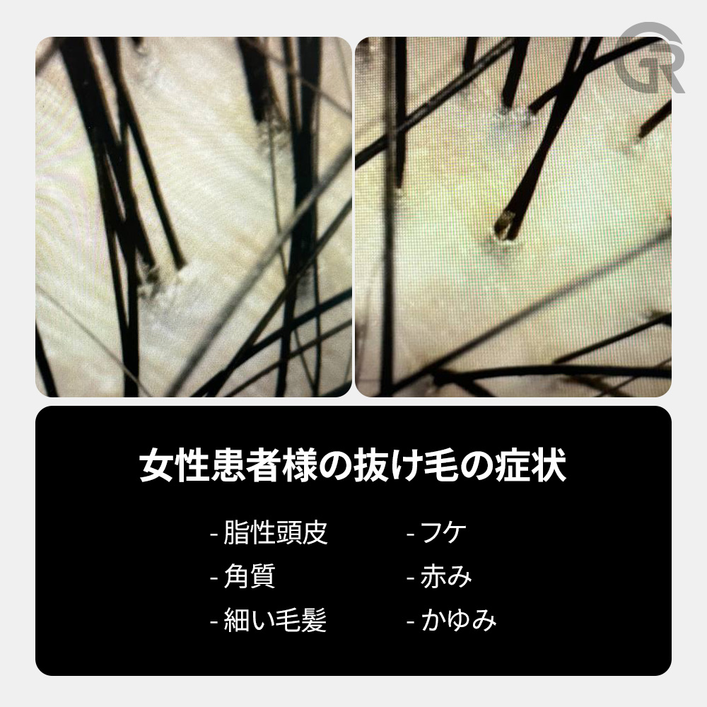 分け目のボリューム低下が気になるケース