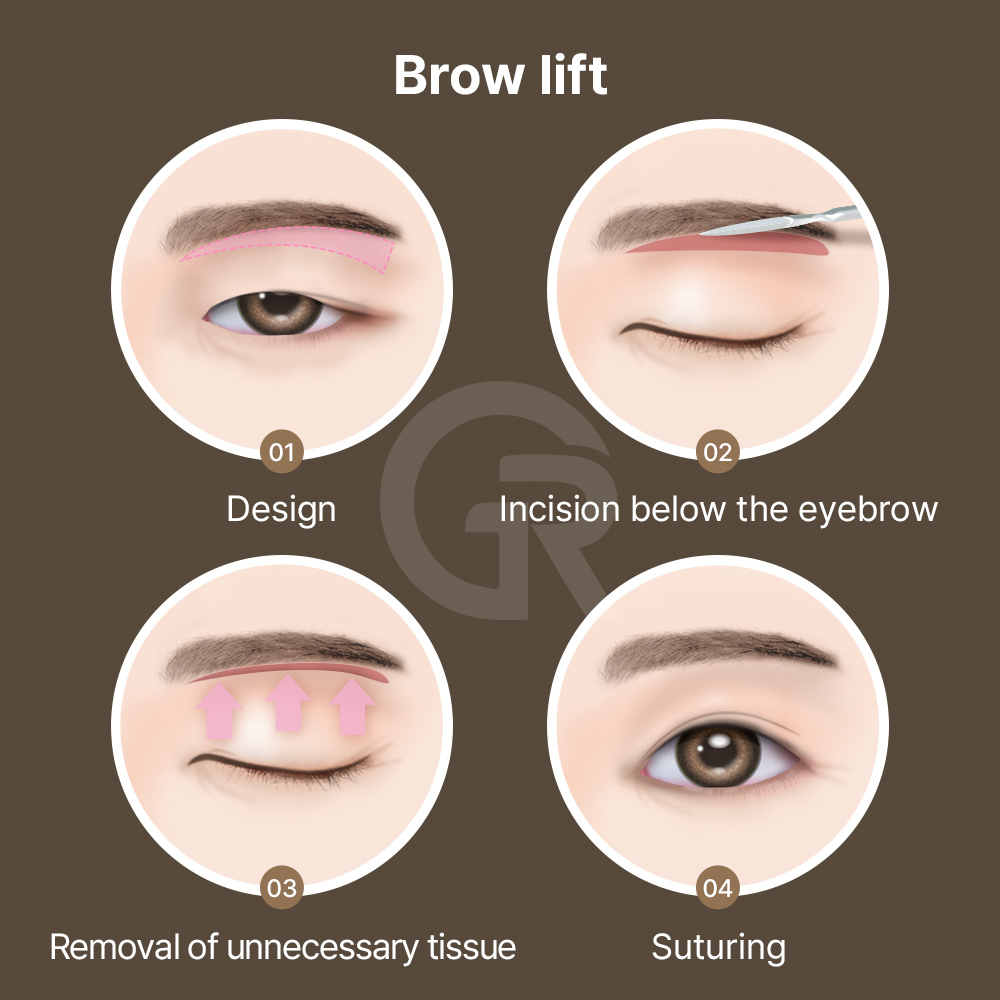 A forehead lift can restore eyebrow position and improve how the eyes naturally open.