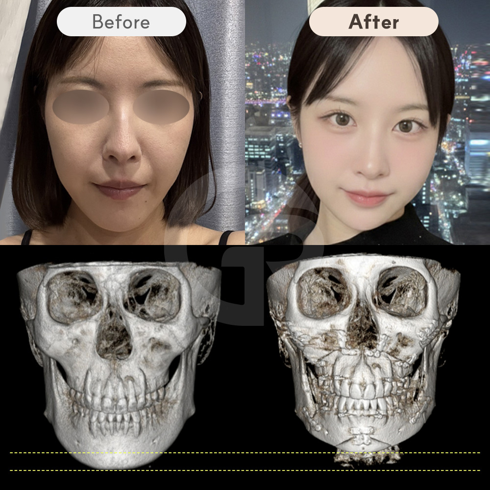3D simulation analysis used in double jaw surgery planning to predict occlusion changes and optimize facial proportions before surgery.