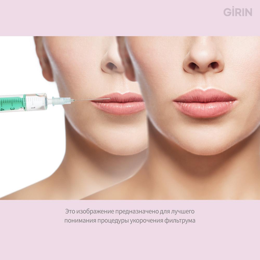 Ботокс для фильтрума сокращает длину при улыбке