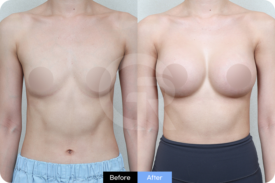 Girin Plastic Surgery Korea Breast Augmentation case 02 Front