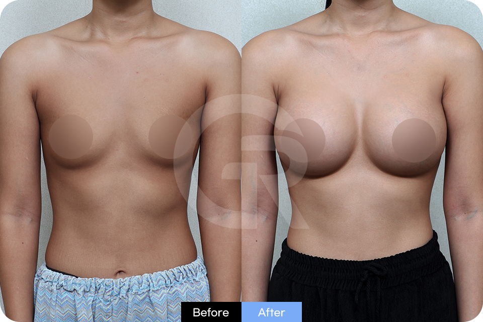 Girin Plastic Surgery Korea Breast Augmentation case 01 Front