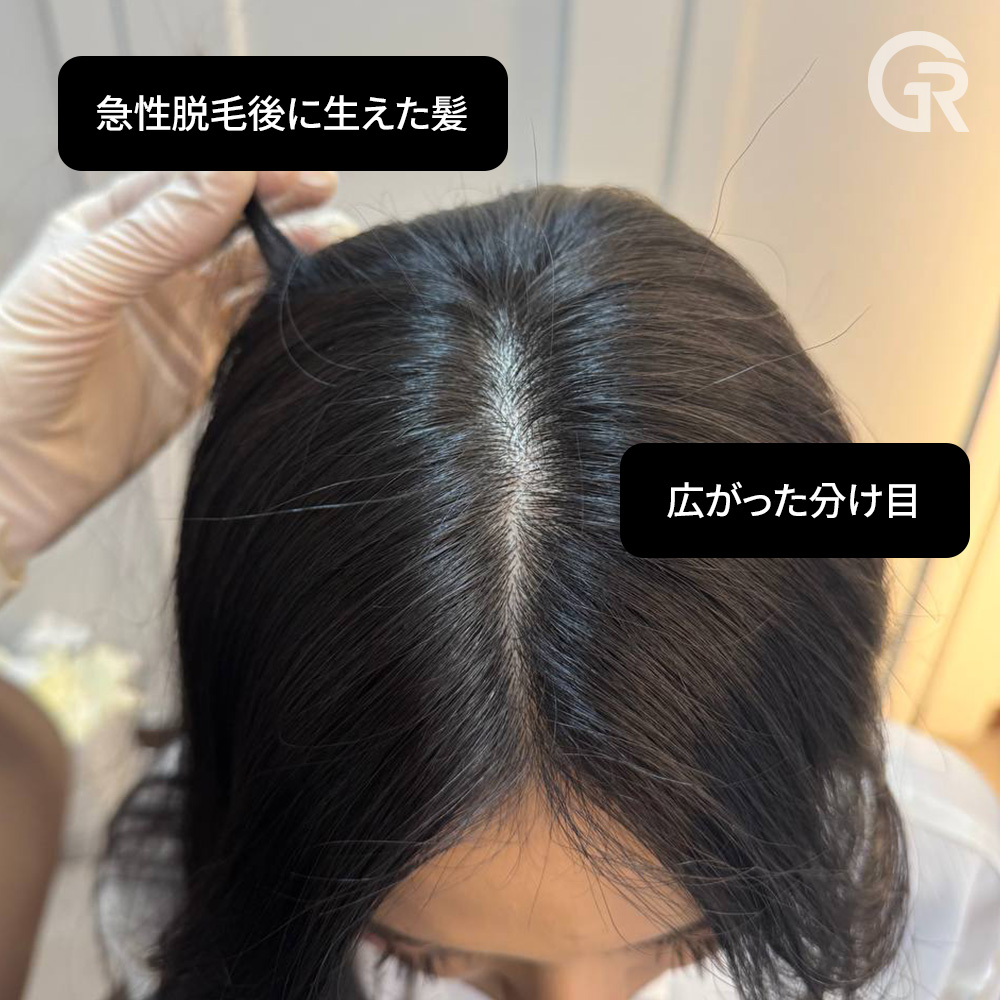 頭皮マイクロスコープによる精密診断