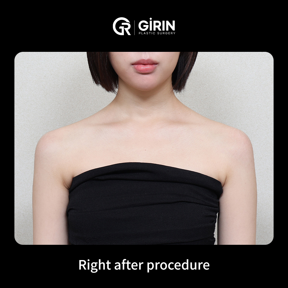 Say goodbye to sloped shoulders — get a defined line at Girin Plastic Surgery