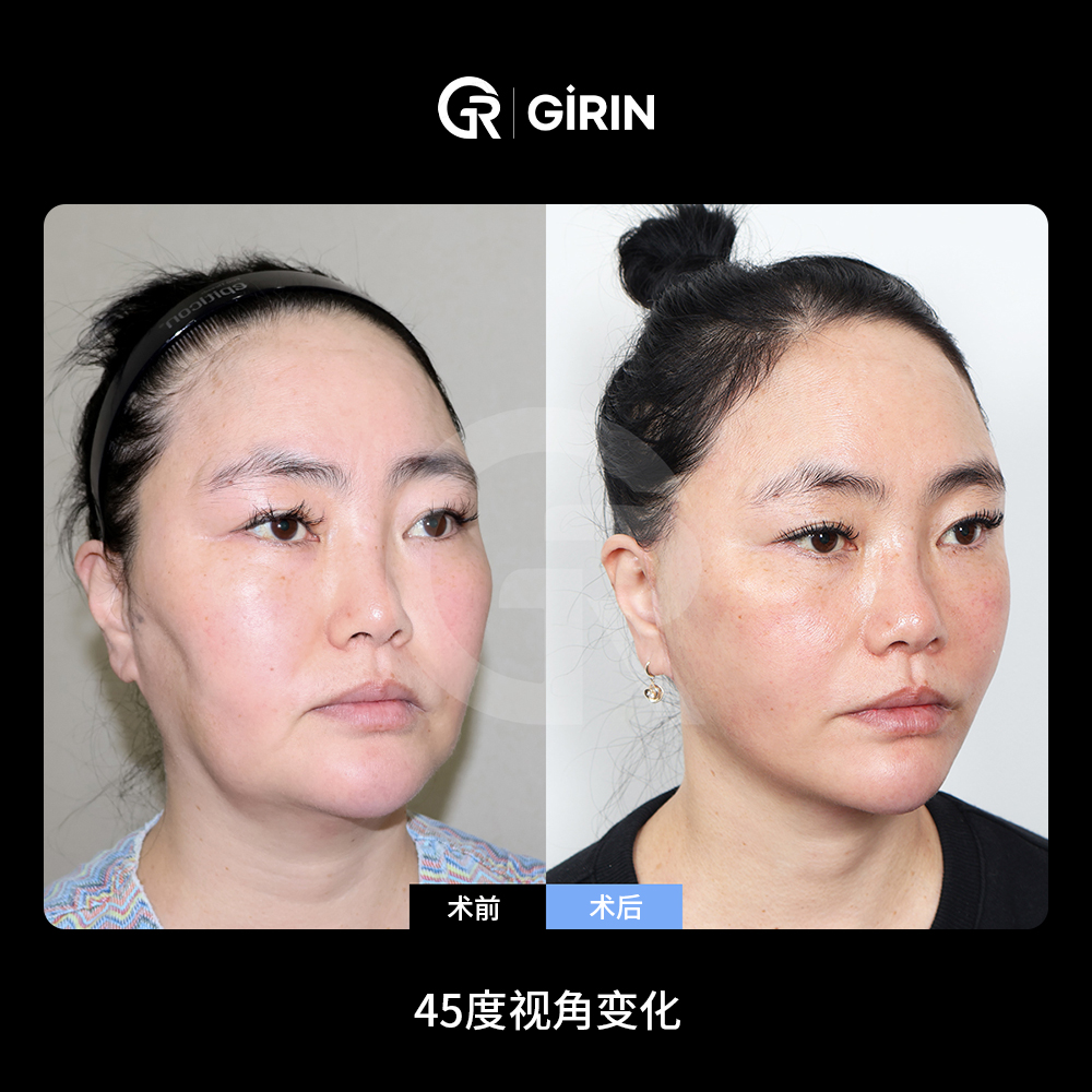 韩国面部拉皮费用因手术方案而异