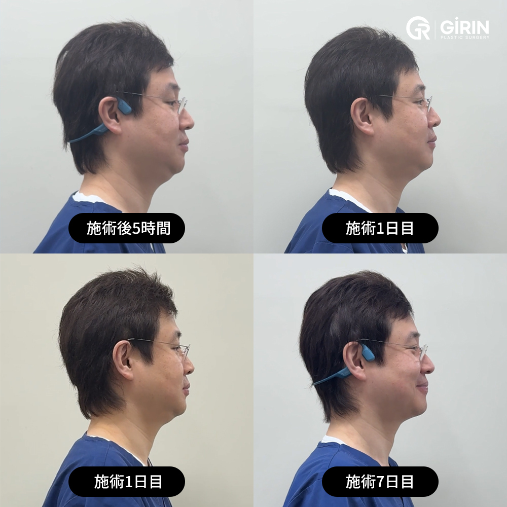 脂肪細胞が分解される仕組み