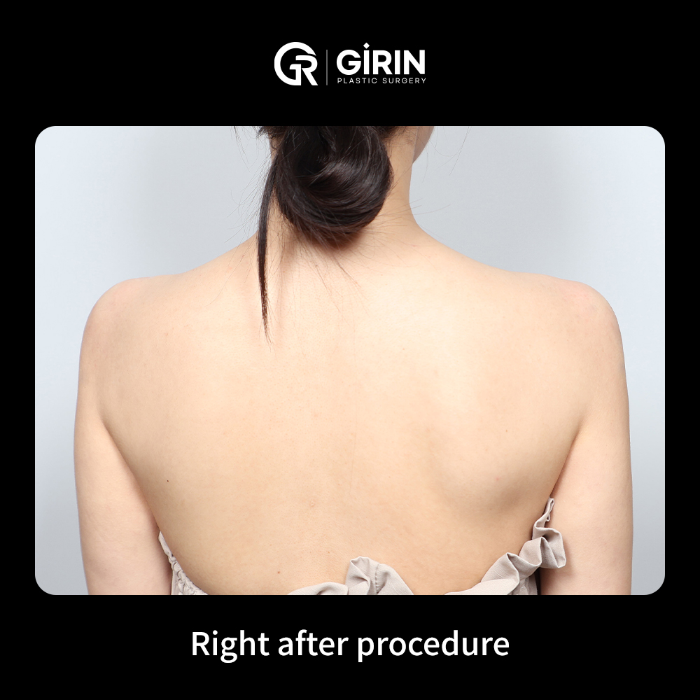 Trusted by local and international patients for shoulder enhancements