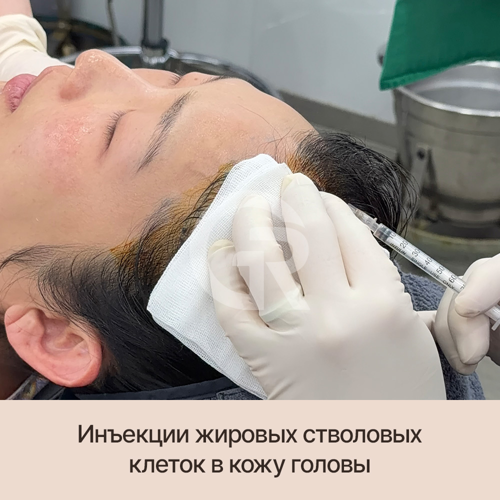 Потеря объема волос? Причина может быть глубже — в ослаблении фолликулов