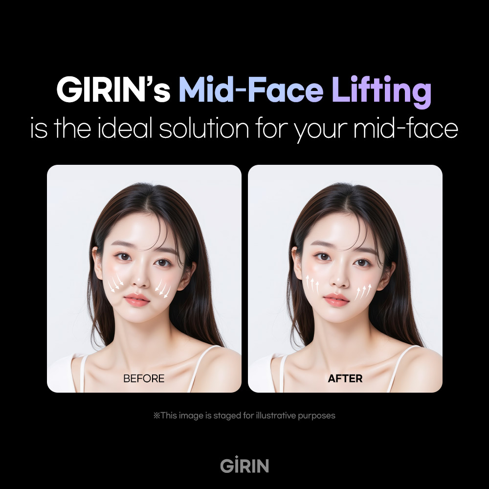 Diagram showing midface ptosis correction with thread lift in Korea