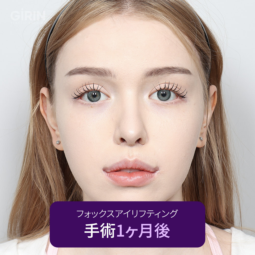 実際の患者症例：自然で魅力的な目元。