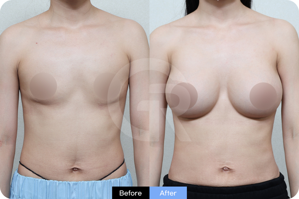 Girin Plastic Surgery Korea Breast Augmentation case 04 Front