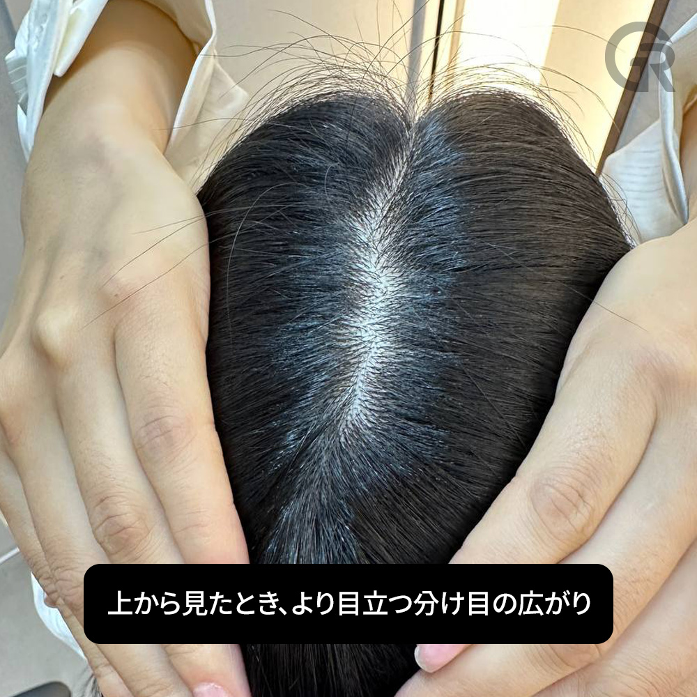 M字生え際が目立ち始めた状態