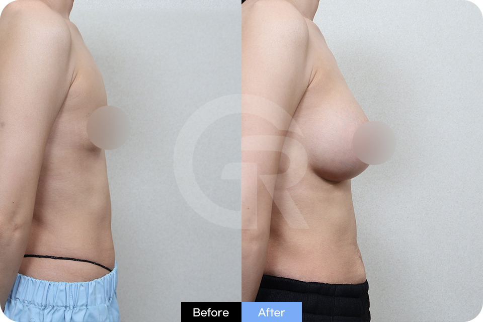 Girin Plastic Surgery Korea Breast Augmentation case 04 Side