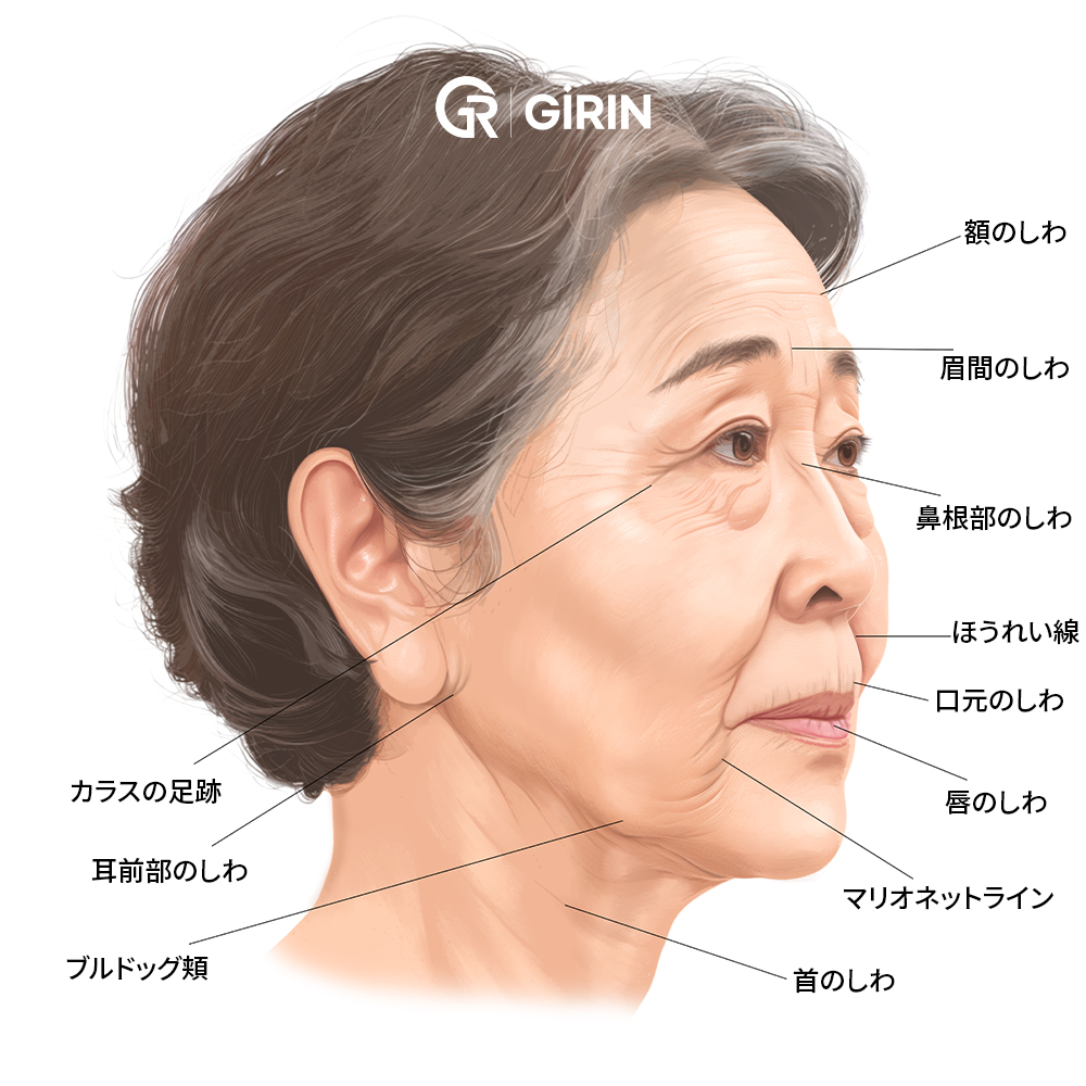 皮膚とSMAS層を同時に引き上げるフルフェイスリフト