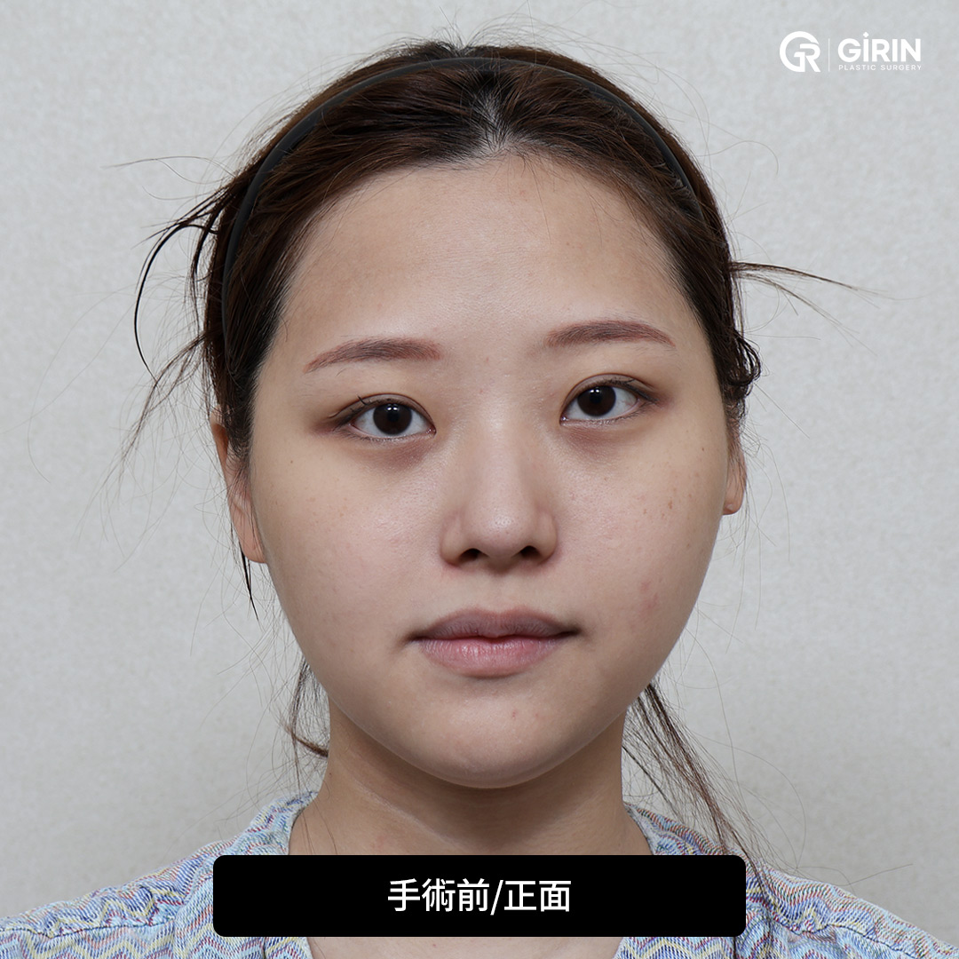 顔の非対称と咬合を精密に修正