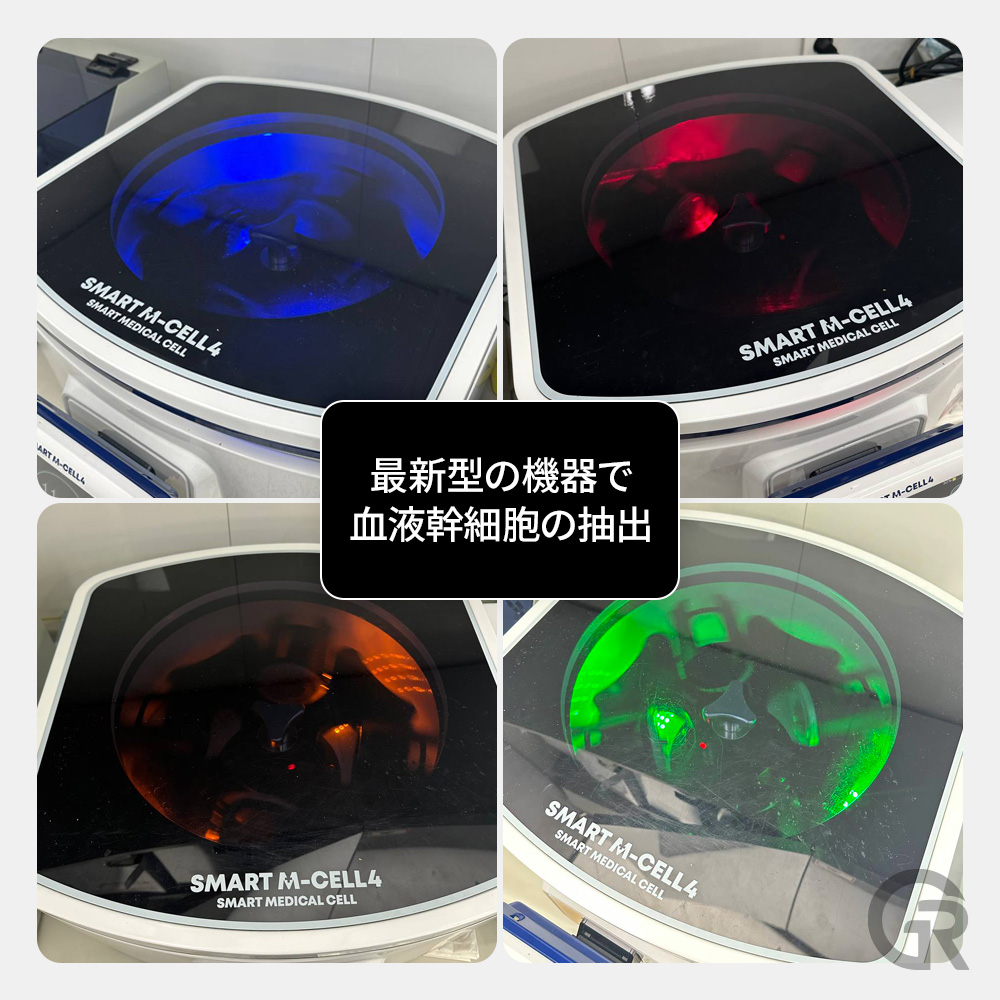 毛髪の細毛化（ミニチュア化）の進行