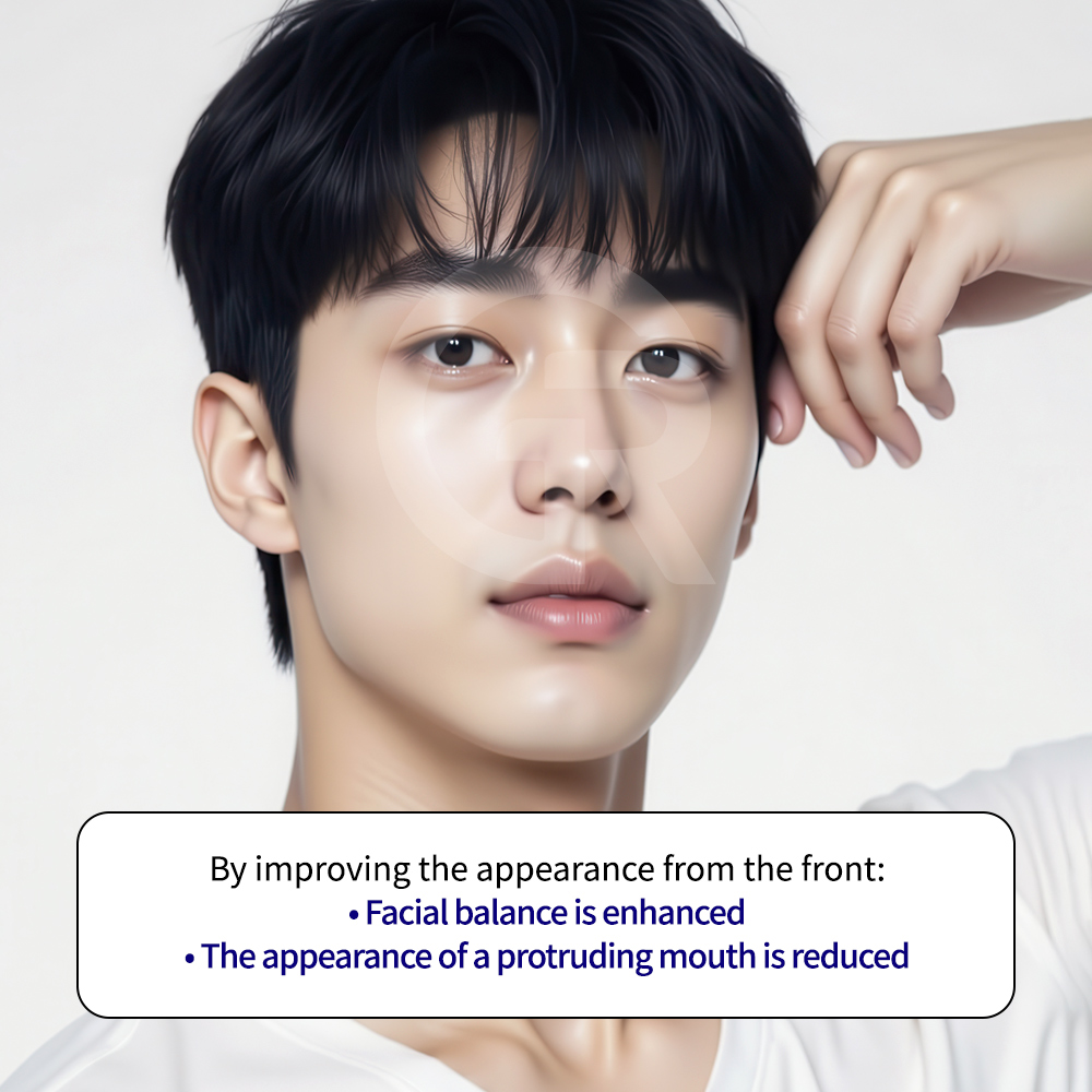 Before and after results of Jellyko rhinoplasty at GIRIN PLASTIC SURGERY, showing balanced nasal structure and natural contour.