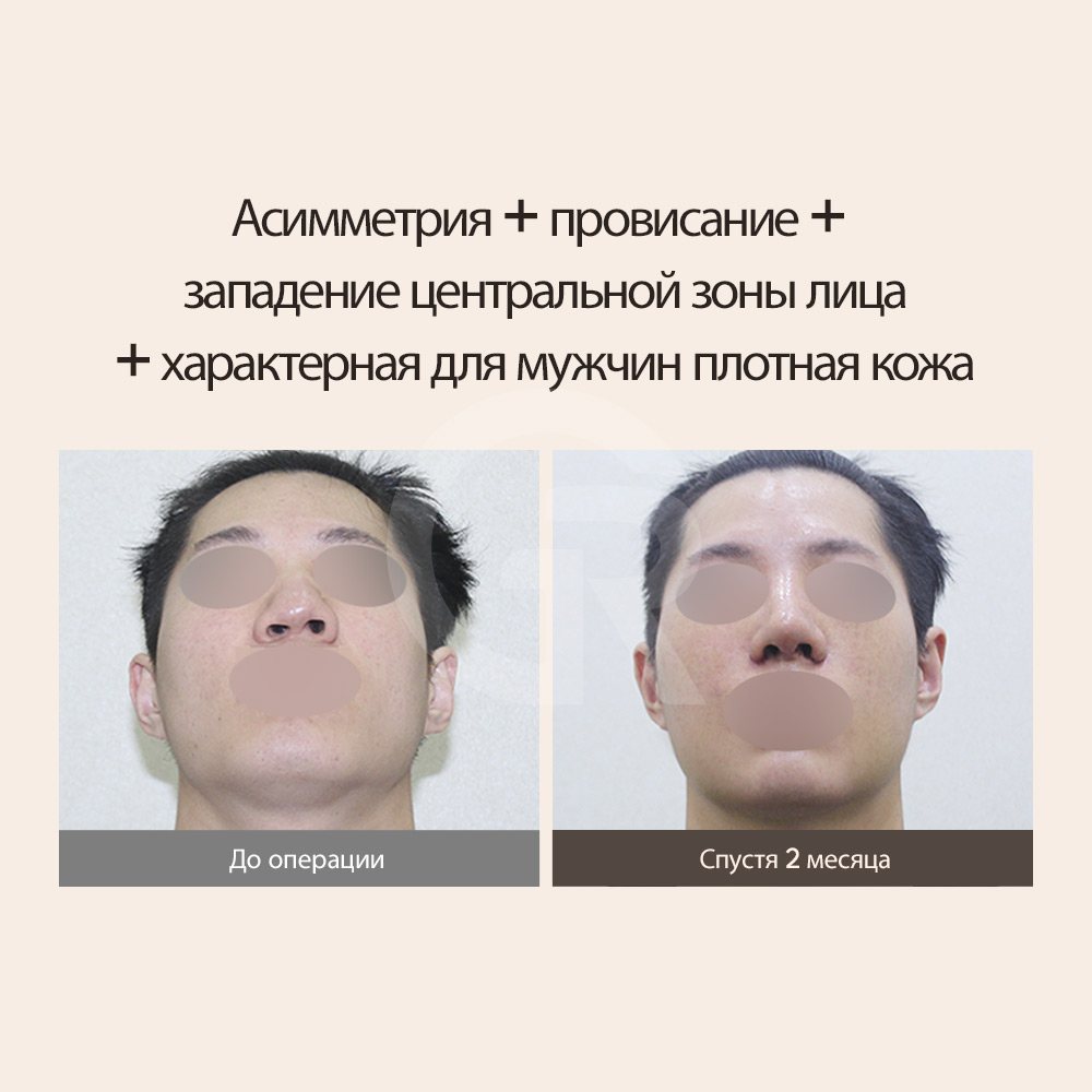 Долгосрочный результат коррекции носа после расщелины губы в Сеуле, Корея.